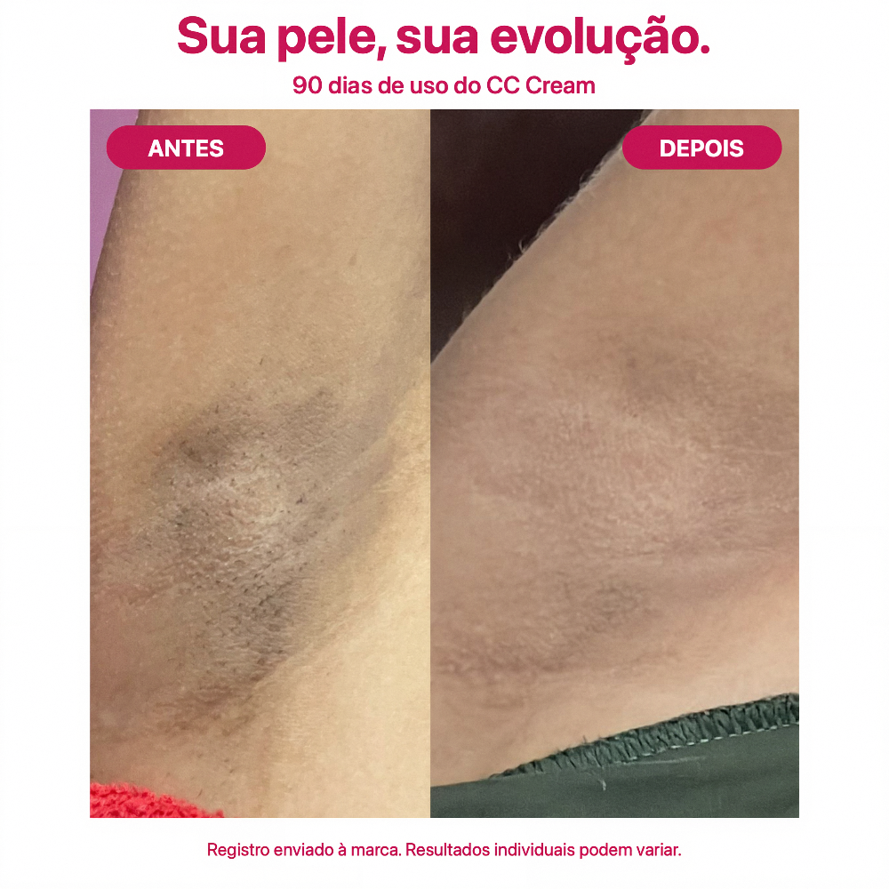 Antes e depois CC Cream Íntimo Aura Mizz após 90 dias — clareamento visível na axila, pele mais uniforme