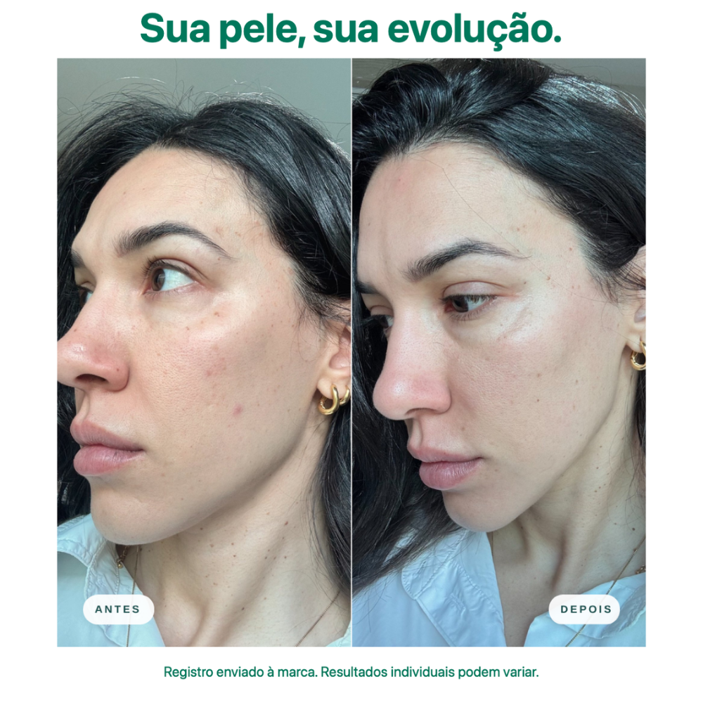 Antes e depois com Creme-Gel Facial Mizz: pele mais hidratada, viço, textura mais uniforme e luminosidade real