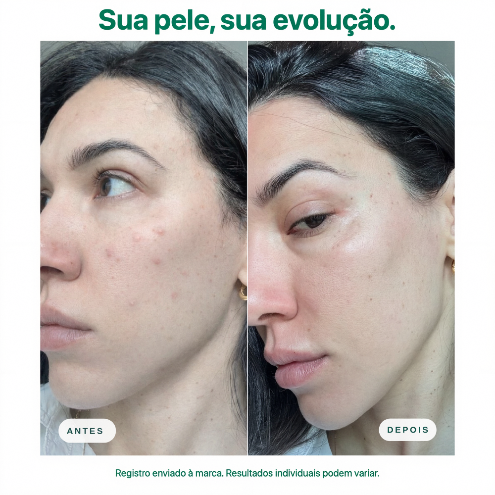 Antes e depois com Espuma de Limpeza Facial Mizz: pele mais uniforme, com menos marcas e mais luminosidade