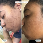 Antes e depois com Kit Anti Manchas Mizz após 30 dias: pele mais uniforme, menos manchas e marcas de acne visíveis