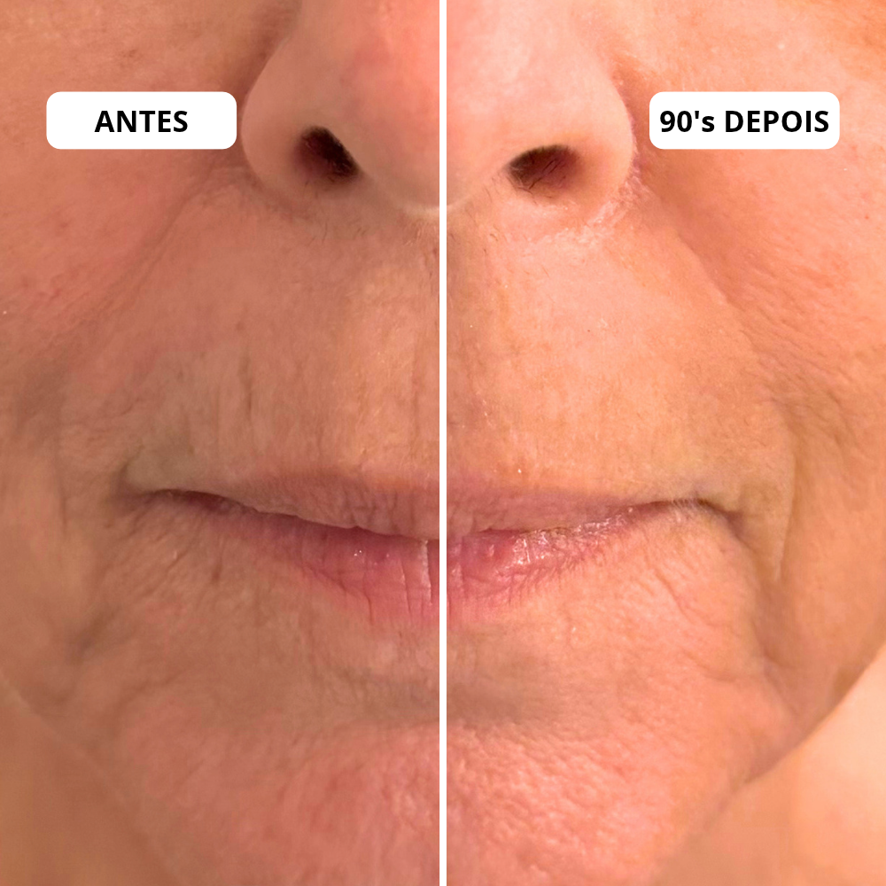 Antes e depois Pep Botulin Mizz — bigode chinês e código de barras acima dos lábios visivelmente suavizados