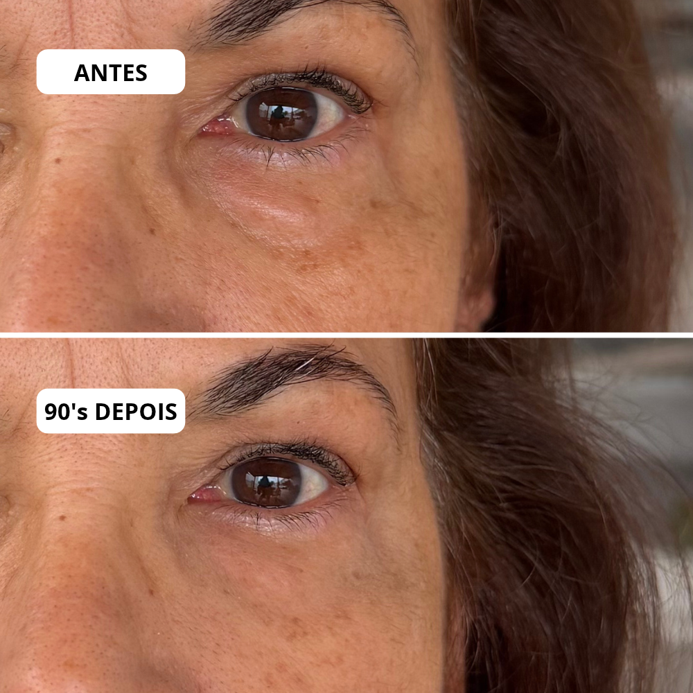 Antes e depois Pep Botulin Mizz — aparência de bolsas inchadas suavizada, área dos olhos mais lisa e luminosa