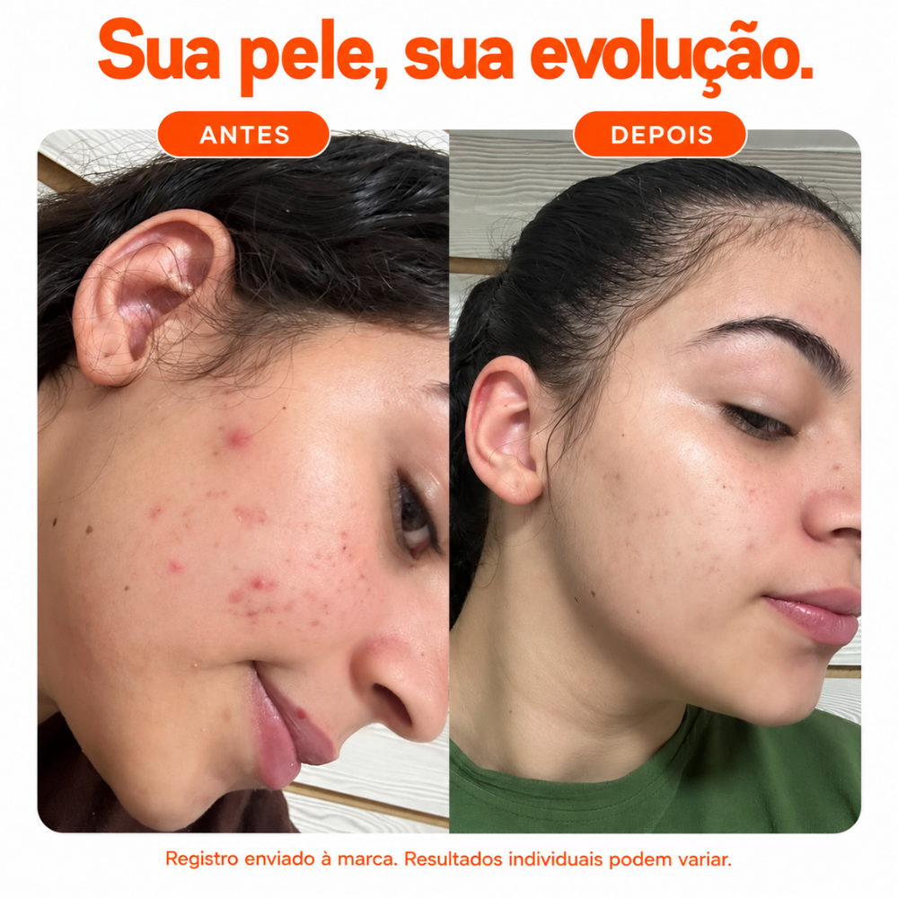 Antes e depois com Sérum Vitamina C 10% Mizz: redução visível de acne e marcas, tom mais uniforme e luminoso
