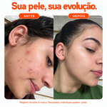 Antes e depois com Sérum Vitamina C 10% Mizz: redução visível de acne e marcas, tom mais uniforme e luminoso