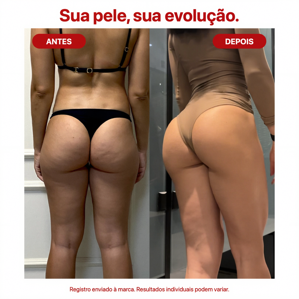Antes e depois Thermo Skin Mizz — redução visível de celulite, pele mais firme e textura mais uniforme