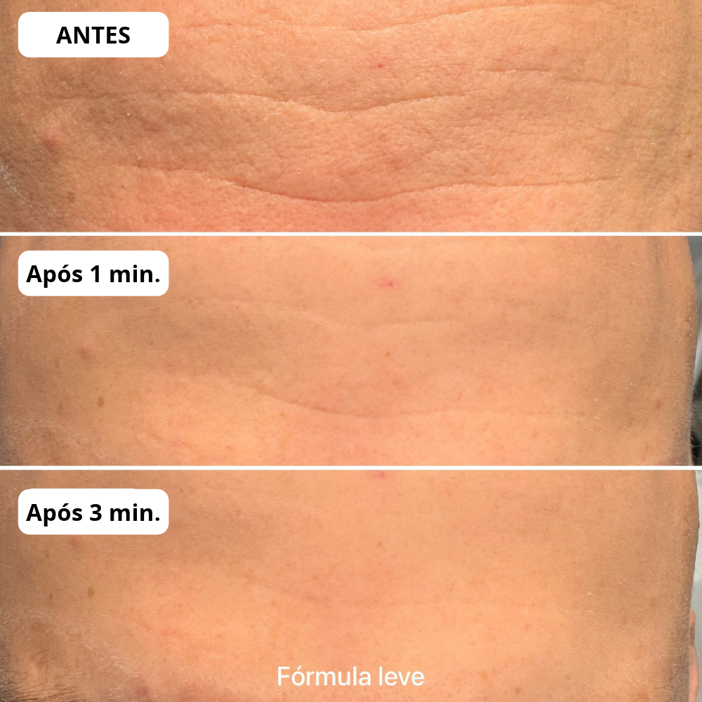 Pep Botulin Mizz — redução visível de linhas em minutos. Testes T-0, T-1min, T-3min comprovam efeito tensor